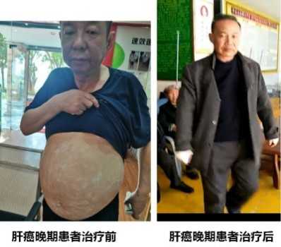 各种癌症先治好病才收治疗费10万元 打底
