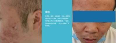 永球适温消融技术创始人  ——宁永球院长