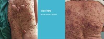 永球适温消融技术创始人  ——宁永球院长