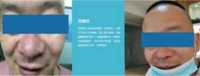 永球适温消融技术创始人  ——宁永球院长