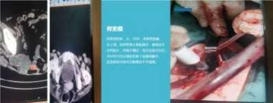 永球适温消融技术创始人  ——宁永球院长