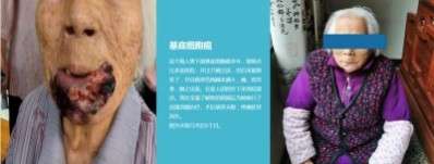 永球适温消融技术创始人  ——宁永球院长